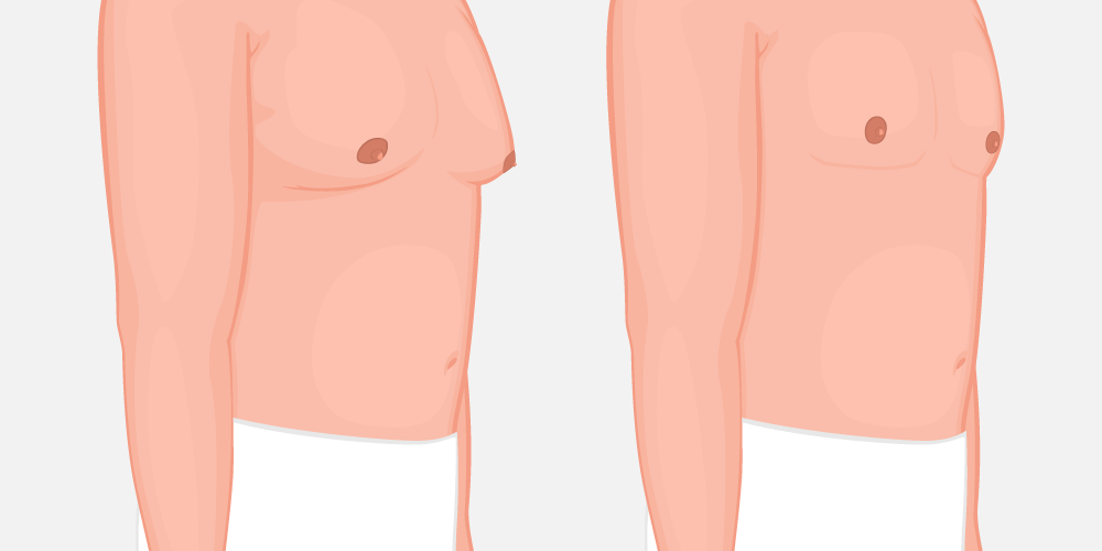 Γυναικομαστία Στους Άνδρες