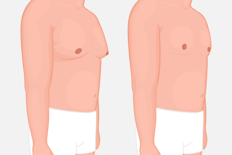 Γυναικομαστία Στους Άνδρες