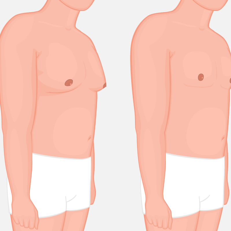Γυναικομαστία Στους Άνδρες