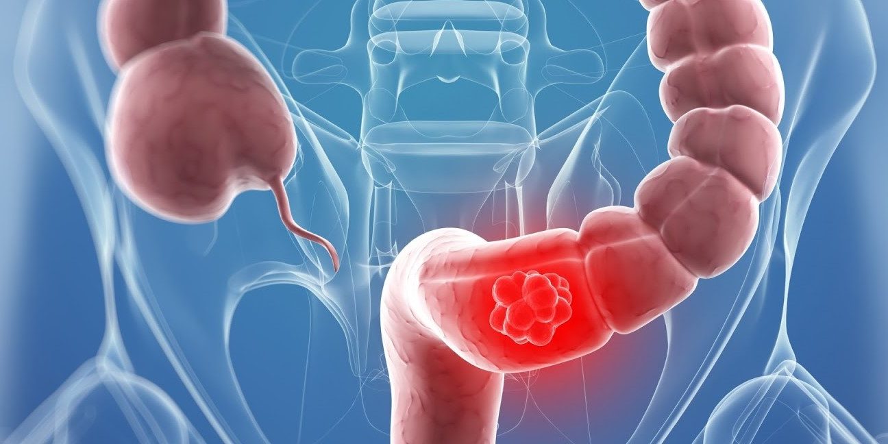 Διάγνωση και θεραπεία του καρκίνου του ορθού