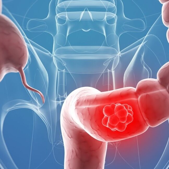 Διάγνωση και θεραπεία του καρκίνου του ορθού