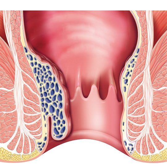 Διατροφή για αιμορροΐδες