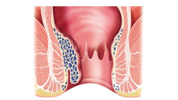Διατροφή για αιμορροΐδες