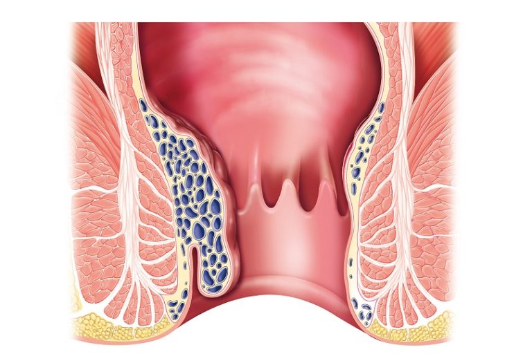 Διατροφή για αιμορροΐδες Διατροφή για αιμορροΐδες
