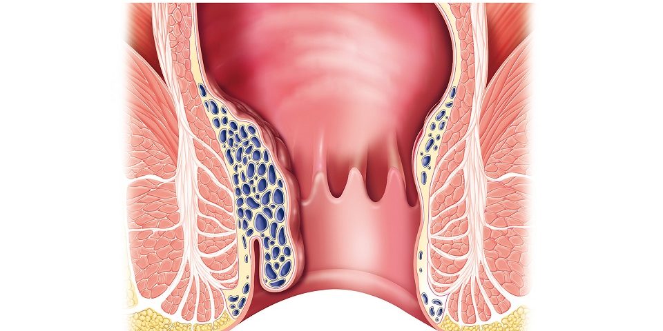 Διατροφή για αιμορροΐδες