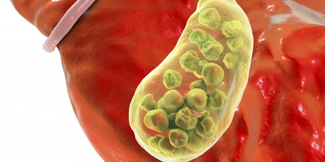 Διατροφή για χοληδόχο κύστη