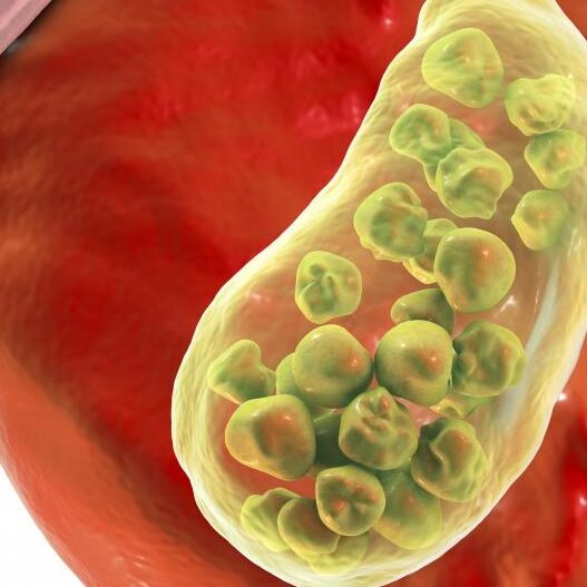 Διατροφή για χοληδόχο κύστη