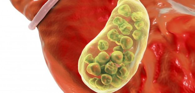 Διατροφή για χοληδόχο κύστη