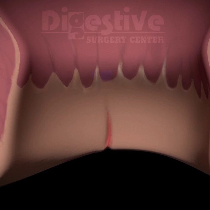 Διαχείριση ασθενών με ραγάδες πρωκτού