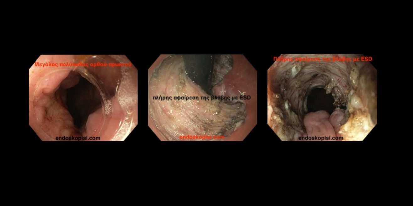 Εκτομή πρώιμου καρκίνου ορθού με ESD