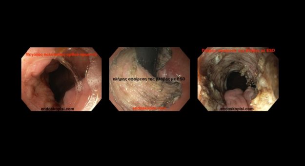 Εκτομή πρώιμου καρκίνου ορθού με ESD