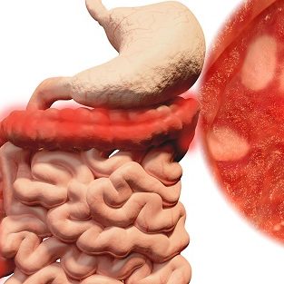 Ελκώδης κολίτιδα