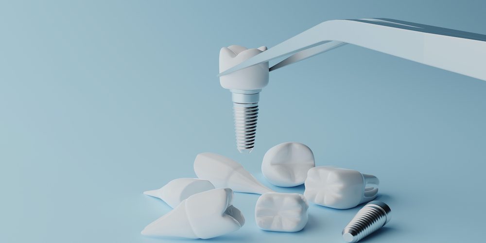 Εμφυτεύματα δοντιών και διάρκεια ζωής τους: Όλα όσα πρέπει να γνωρίζετε Εμφυτεύματα δοντιών και διάρκεια ζωής τους: Όλα όσα πρέπει να γνωρίζετε