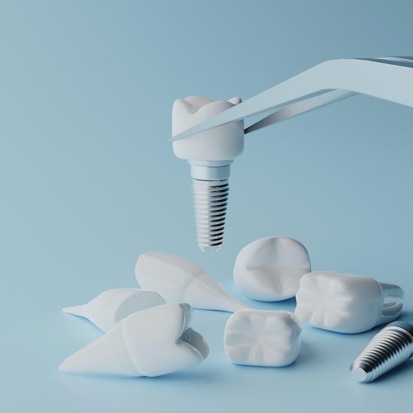 Εμφυτεύματα δοντιών και διάρκεια ζωής τους: Όλα όσα πρέπει να γνωρίζετε