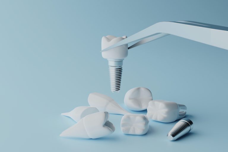 Εμφυτεύματα δοντιών και διάρκεια ζωής τους: Όλα όσα πρέπει να γνωρίζετε