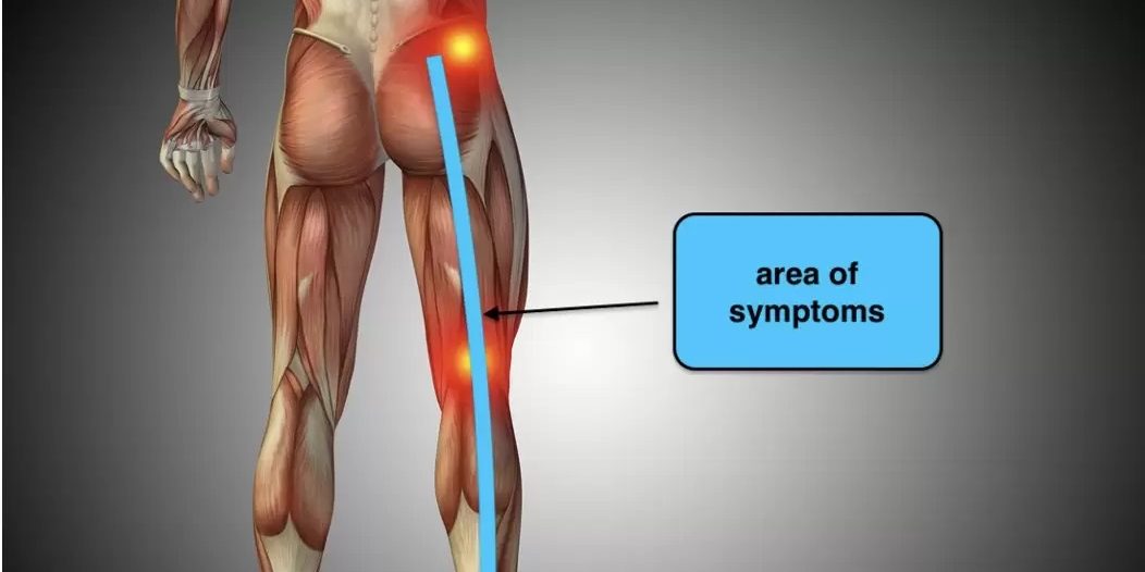 Ενδομητρίωση του Ισχιακού νεύρου