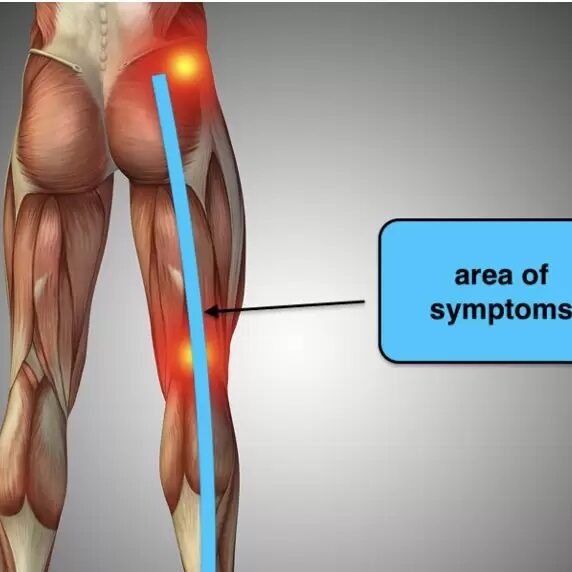 Ενδομητρίωση του Ισχιακού νεύρου