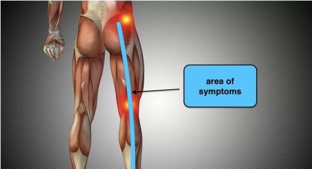 Ενδομητρίωση του Ισχιακού νεύρου