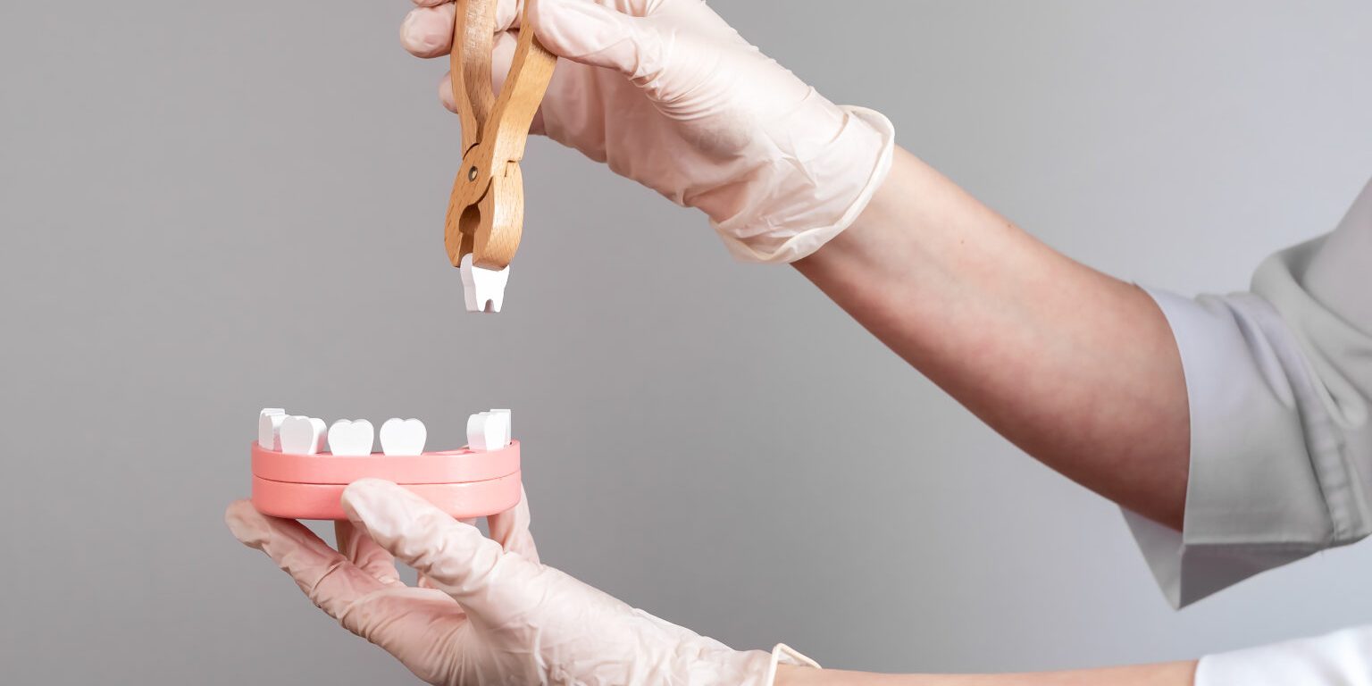 Εξαγωγή δοντιού Εξαγωγή δοντιού