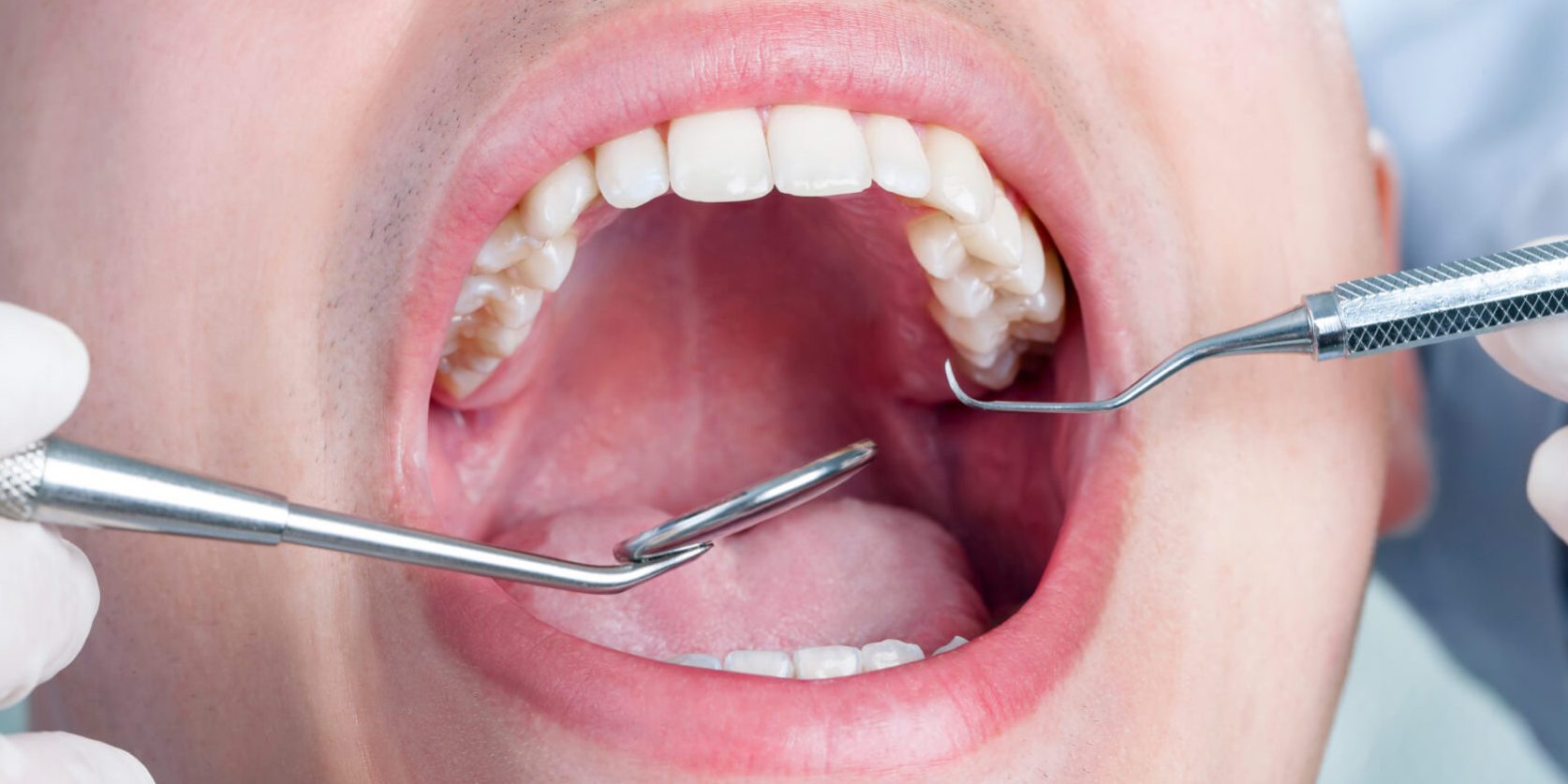 Εξαγωγή φρονιμιτών μετά την ορθοδοντική θεραπεία Εξαγωγή φρονιμιτών μετά την ορθοδοντική θεραπεία