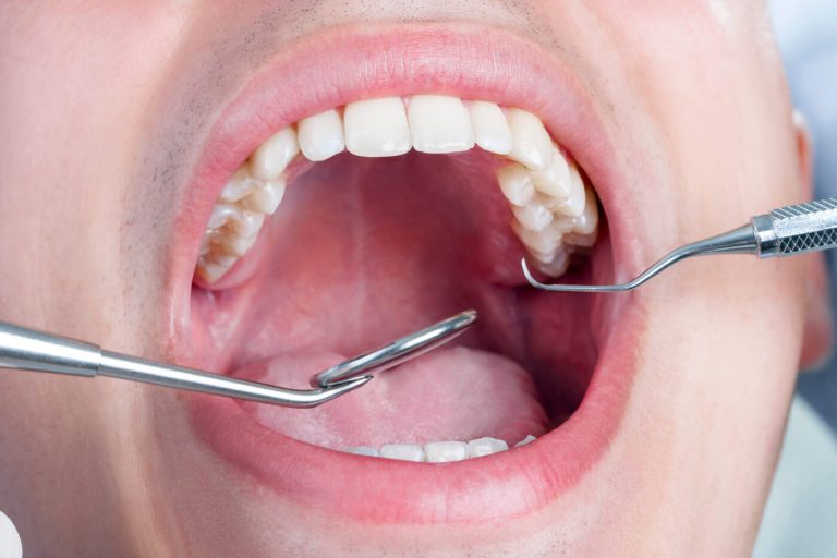 Εξαγωγή φρονιμιτών μετά την ορθοδοντική θεραπεία