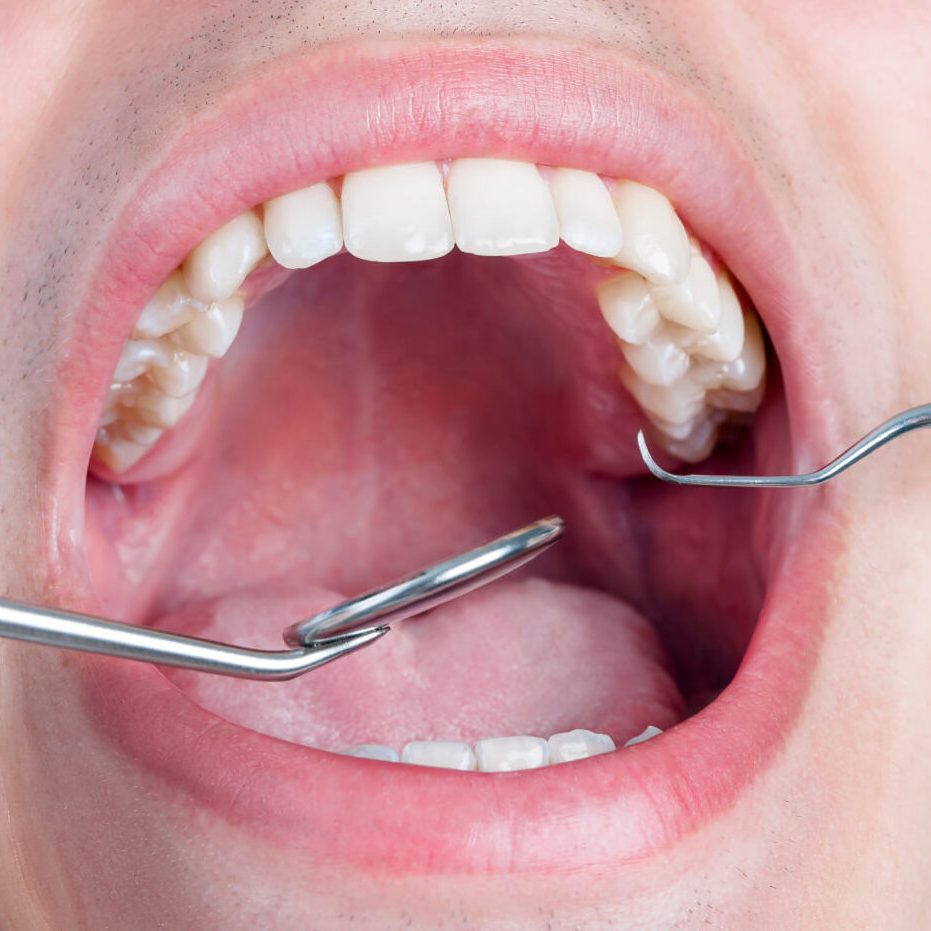 Εξαγωγή φρονιμιτών μετά την ορθοδοντική θεραπεία