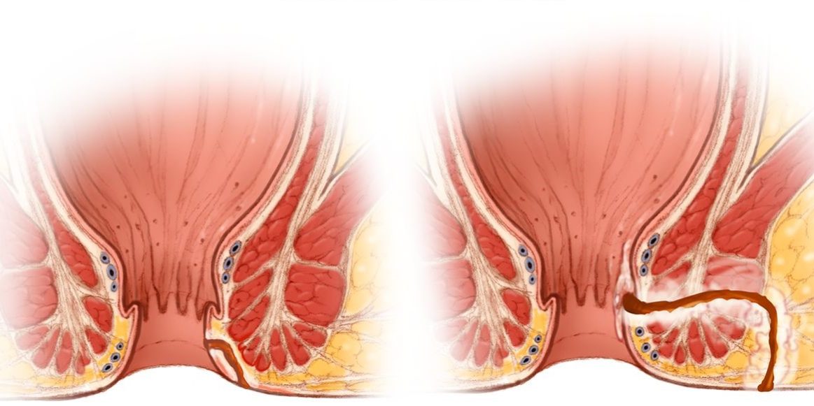 Επιπλοκές από επέμβαση πρωκτικού συριγγίου