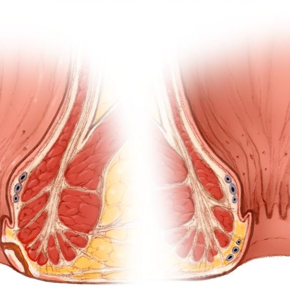 Επιπλοκές από επέμβαση πρωκτικού συριγγίου