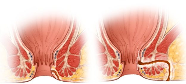 Επιπλοκές από επέμβαση πρωκτικού συριγγίου