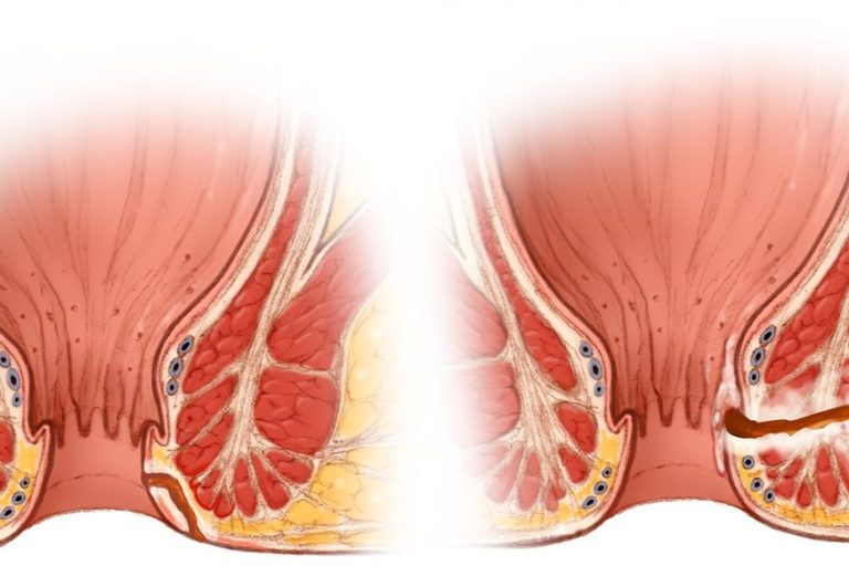 Επιπλοκές από επέμβαση πρωκτικού συριγγίου Επιπλοκές από επέμβαση πρωκτικού συριγγίου