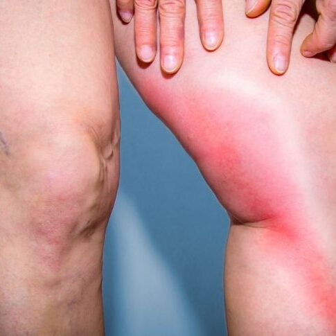 Επιπολής Θρομβοφλεβίτιδα: Αιτίες, Συμπτώματα, Επιπλοκές & Θεραπεία