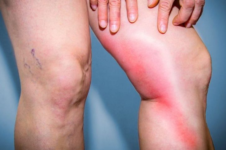 Επιπολής Θρομβοφλεβίτιδα: Αιτίες, Συμπτώματα, Επιπλοκές & Θεραπεία Επιπολής Θρομβοφλεβίτιδα: Αιτίες, Συμπτώματα, Επιπλοκές & Θεραπεία