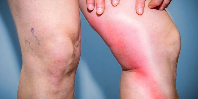 Επιπολής Θρομβοφλεβίτιδα: Αιτίες, Συμπτώματα, Επιπλοκές & Θεραπεία