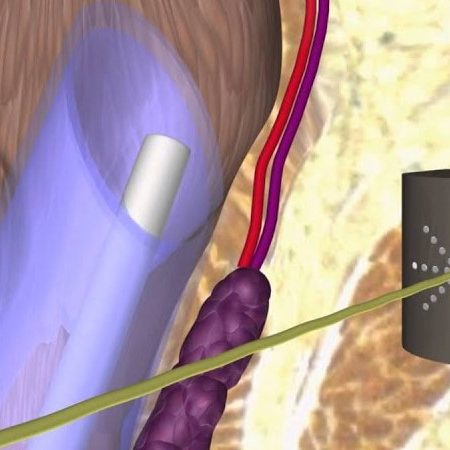 Η θεραπεία της αιμορροϊδοπάθειας είναι πλέον ανώδυνη και οριστική!