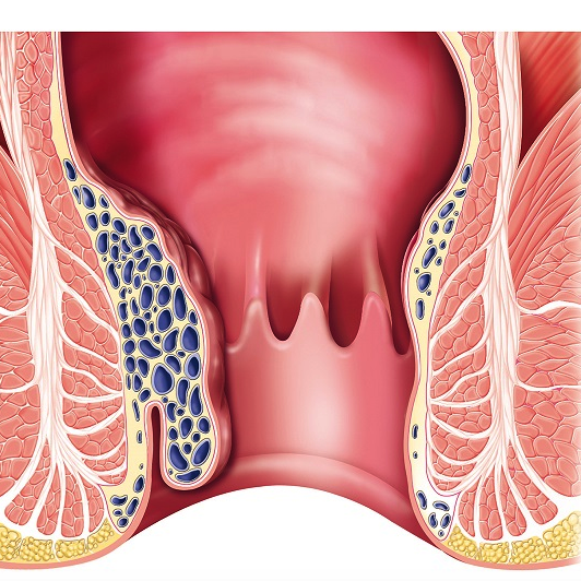 Η θεραπεία της αιμορροϊδοπάθειας είναι πλέον ανώδυνη και οριστική!