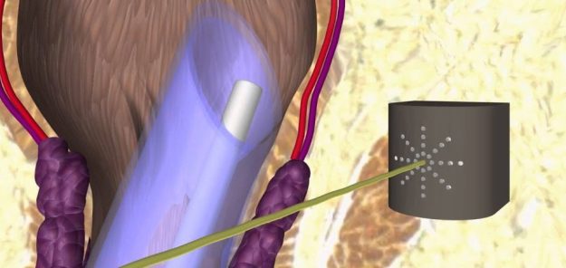 Η θεραπεία της αιμορροϊδοπάθειας είναι πλέον ανώδυνη και οριστική!