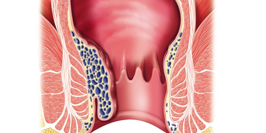 Η θεραπεία της αιμορροϊδοπάθειας είναι πλέον ανώδυνη και οριστική!