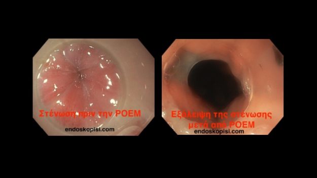 Θεραπεία Αχαλασίας οισοφάγου σε ασθενή 80 ετών με POEM