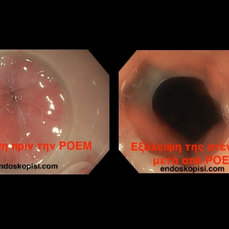 Θεραπεία Αχαλασίας οισοφάγου σε ασθενή 80 ετών με POEM