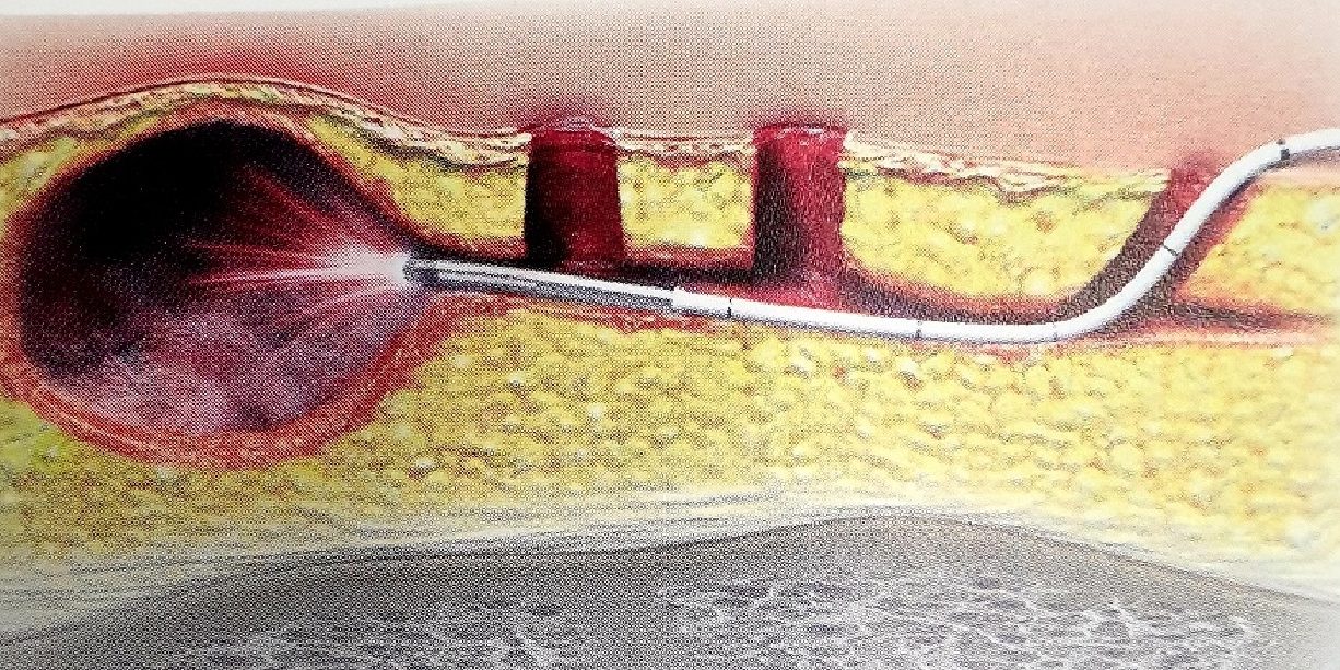 Θεραπείες για πρωκτικό συρίγγιο