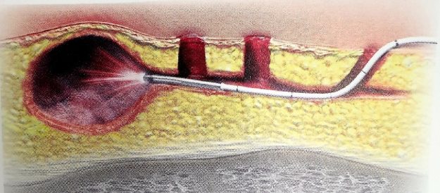 Θεραπείες για πρωκτικό συρίγγιο