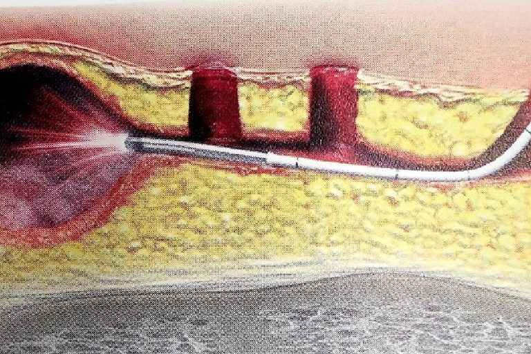 Θεραπείες για πρωκτικό συρίγγιο