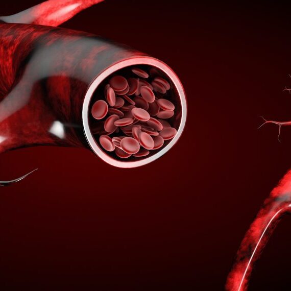 Θρόμβωση Φλεβών Στο Πόδι: Παράγοντες Κινδύνου, Συμπτώματα Και Θεραπεία