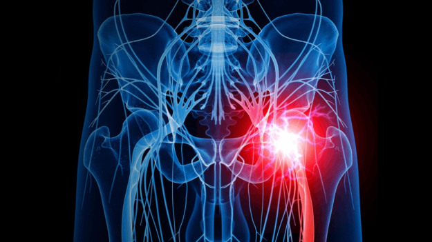 Ισχιαλγία: Ποια είναι τα πιο συχνά αίτια;