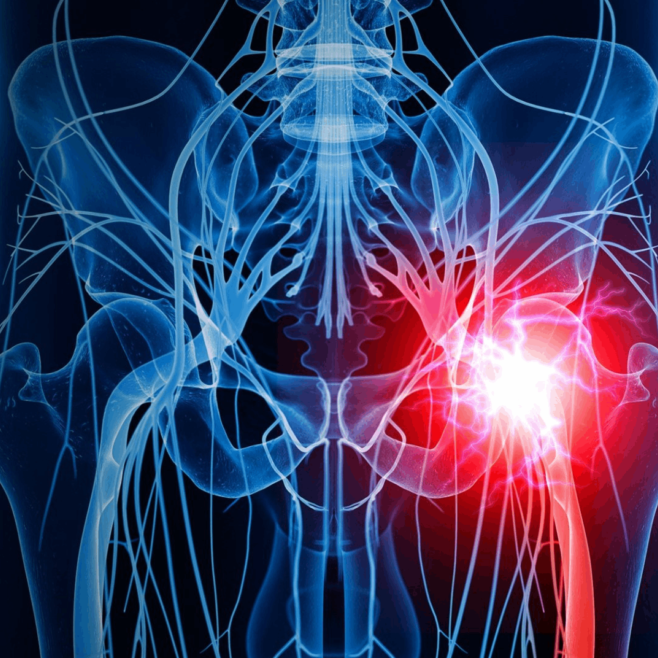 Ισχιαλγία: Ποια είναι τα πιο συχνά αίτια;