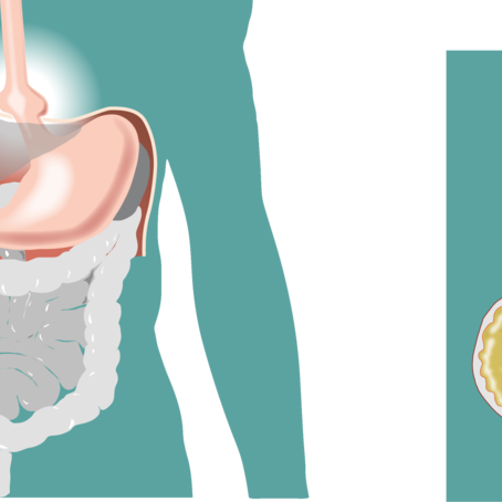 Κήλες, αιτίες και θεραπείες