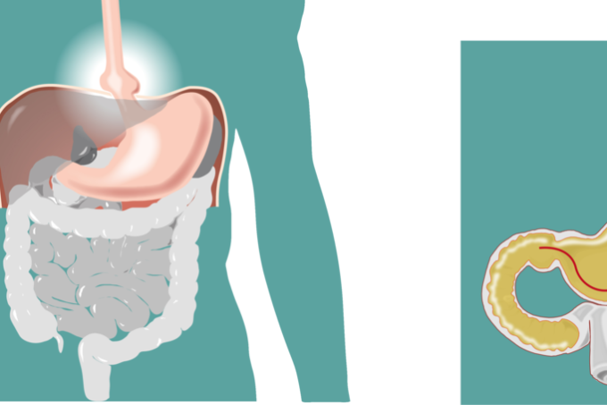 Κήλες, αιτίες και θεραπείες
