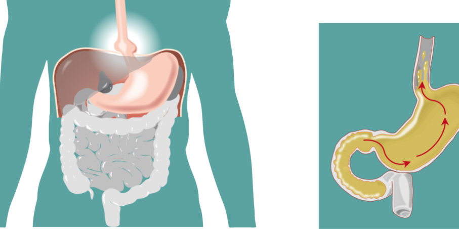 Κήλες, αιτίες και θεραπείες Κήλες, αιτίες και θεραπείες