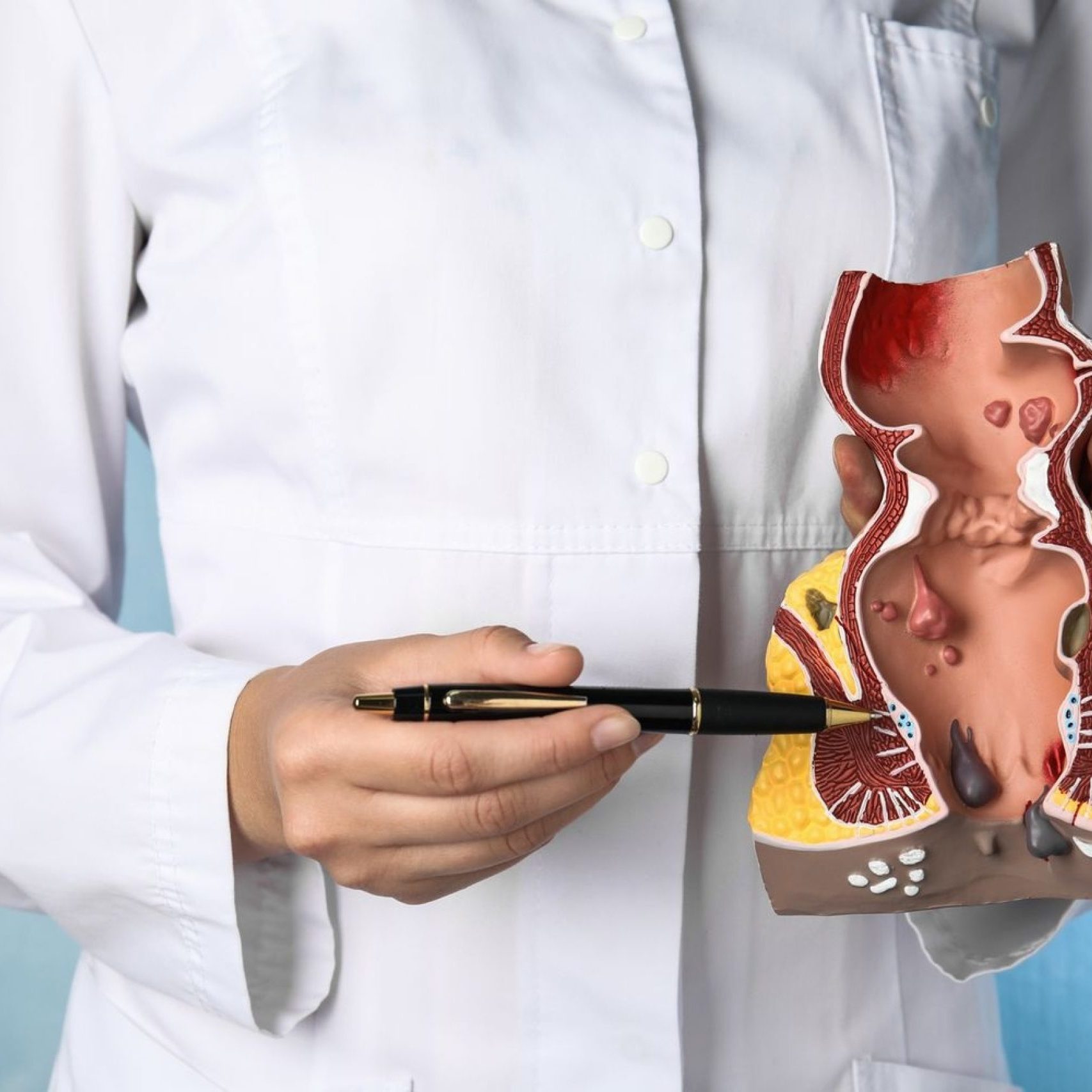 Καρκίνος Πρωκτού: Αίτια και Συμπτώματα