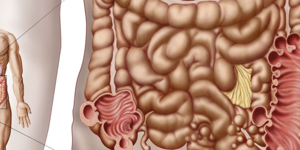 Καρκίνος του ορθού